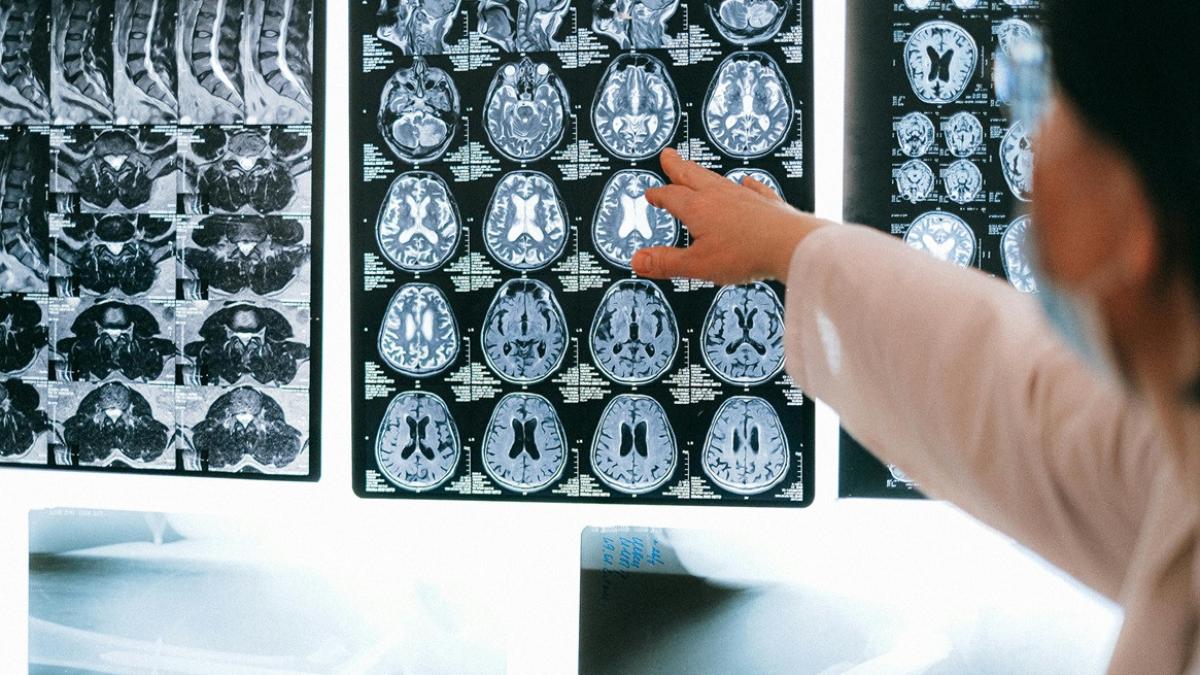 accidentul-vascular-cerebral.jpg
