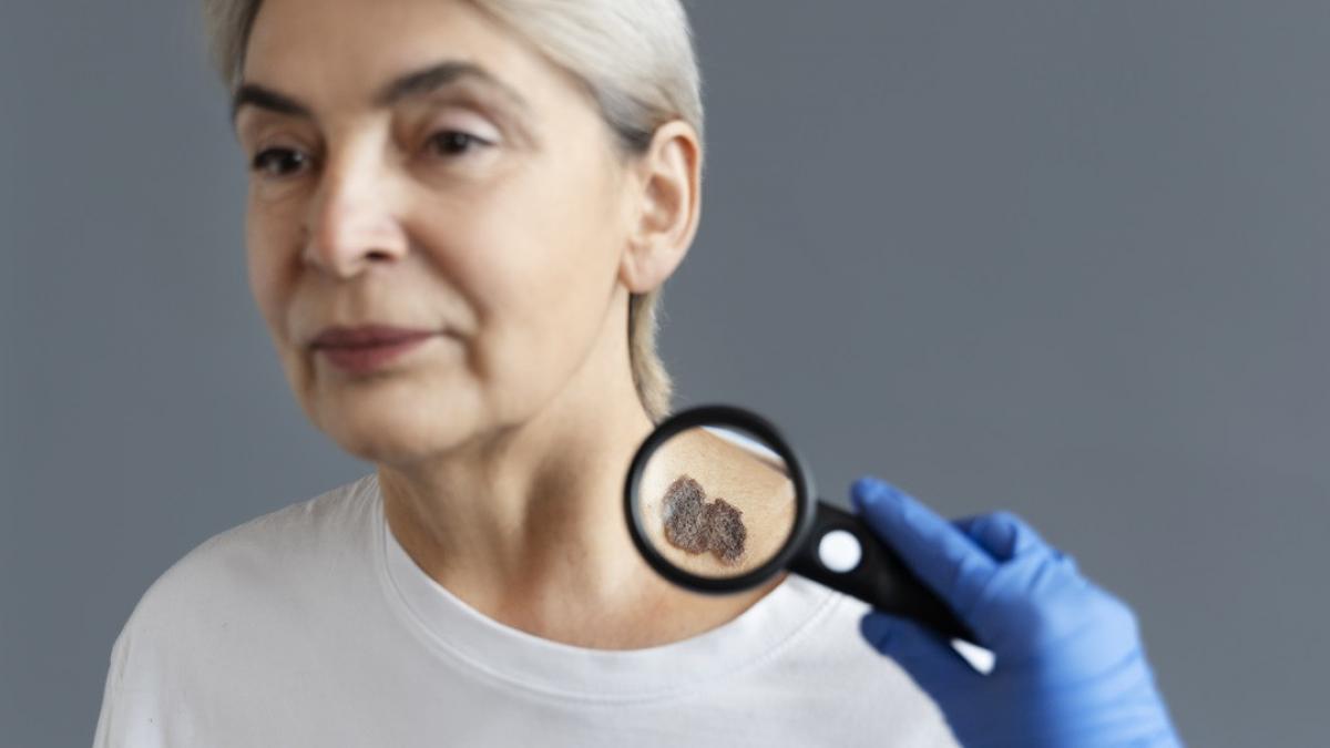 melanomul