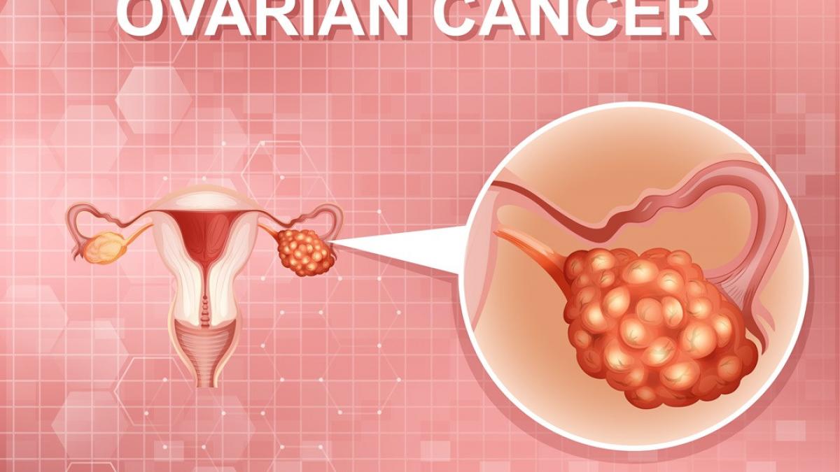 cancer ovarian