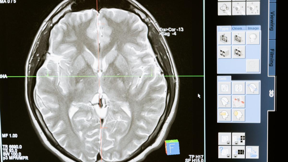 neuroplasticitatea creierului