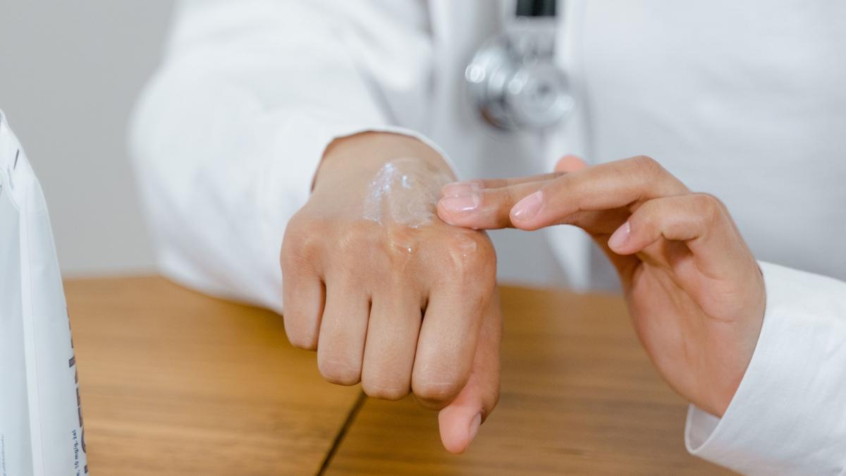eczema