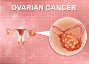 iata cum se raspandeste cancerul ovarian inainte ca medicii sa l poata depista