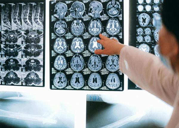5 semne ascunse ale tumorii cerebrale pe care multi le ignora sfatul neurochirurgilor