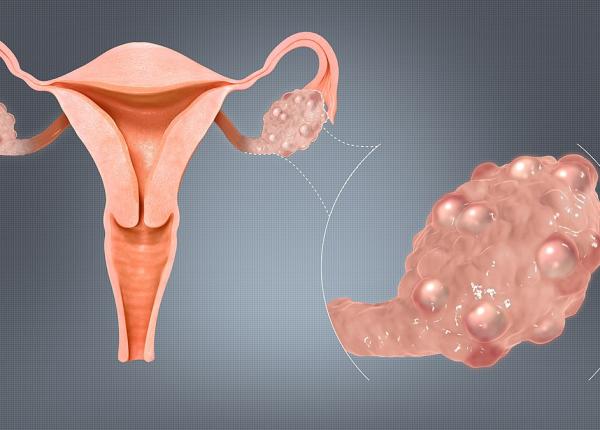 sindromul ovarelor polichistice simptome cauze si tratament