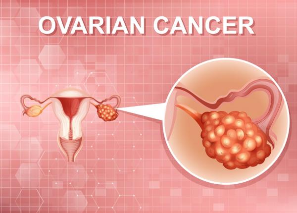 iata cum se raspandeste cancerul ovarian inainte ca medicii sa l poata depista