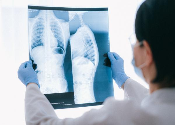rata de supravietuire si speranta de viata dupa transplantul pulmonar
