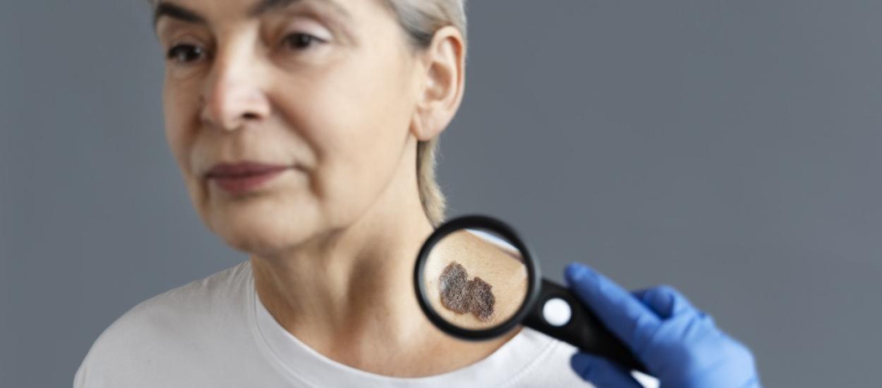 Cum celulele senescente favorizează creșterea melanomului