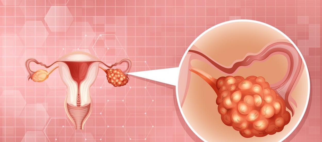 Iată cum se răspândește cancerul ovarian înainte ca medicii să-l poată depista