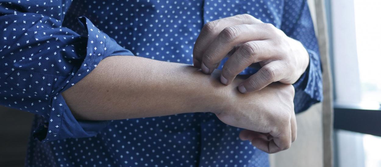 Psoriazisul vara: cum poți reduce puseele și îți poți calma pielea