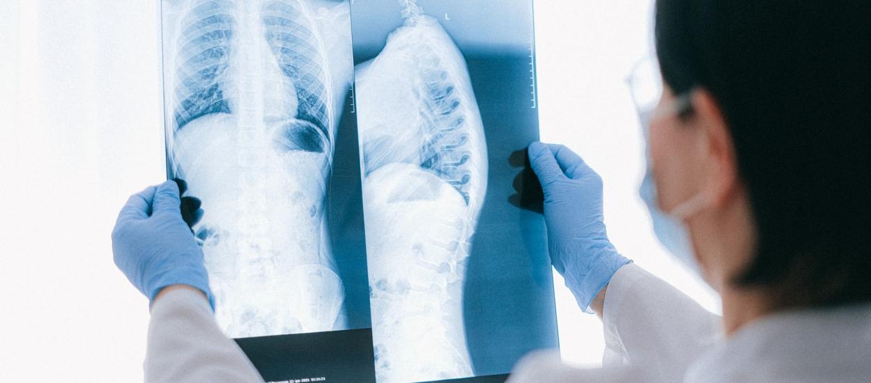 Rata de supraviețuire și speranța de viață după transplantul pulmonar
