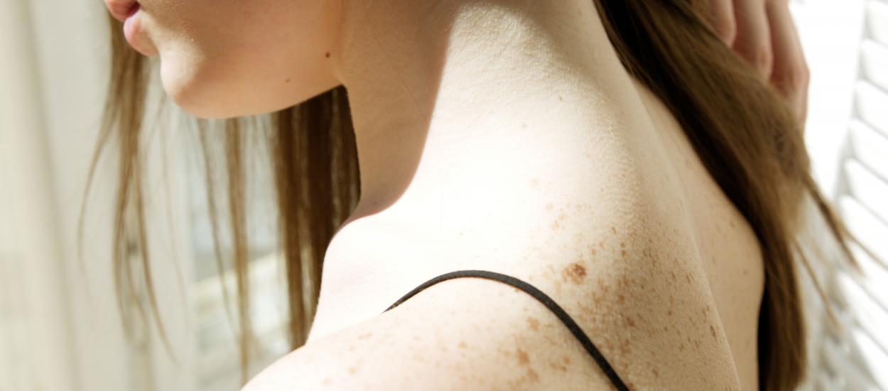 Revoluție în oncologie: VACCINUL împotriva melanomului obține un succes istoric