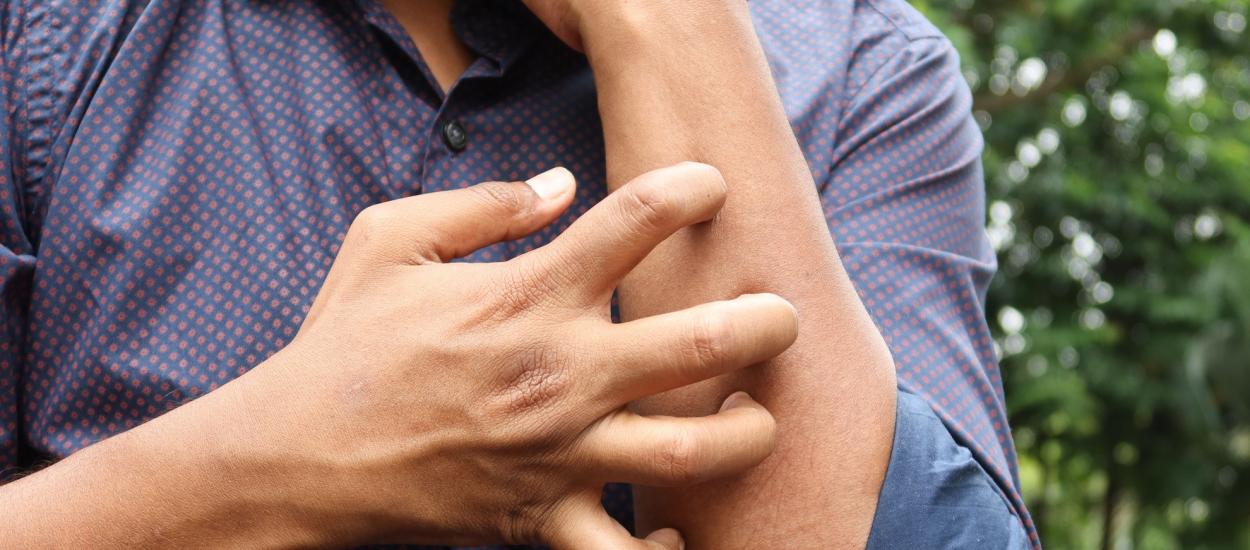 Dermatita atopică poate fi la fel de imprevizibilă ca vremea. Iată cum să o ții sub control